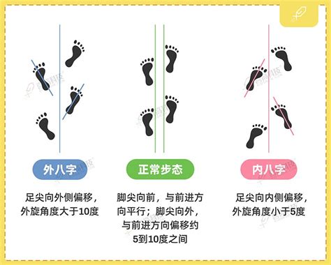 外八字走路|走路“内八”或“外八”？2套方案解决它！